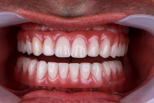 #### Temporary dentures 
*6/13* * *
