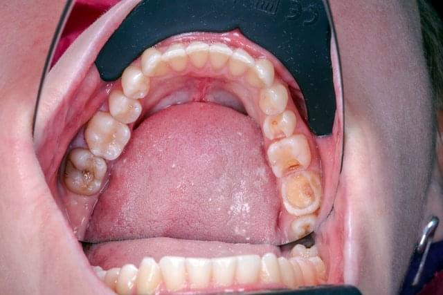 #### Lower jaw teeth preparation
*8/10* * *