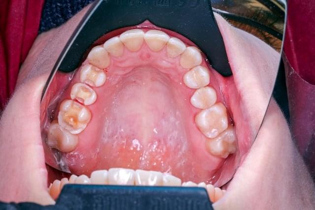#### Upper jaw teeth preparation
*9/10* * *