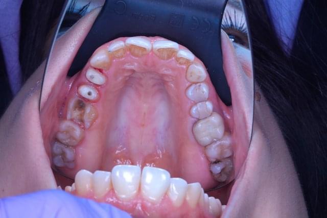 ####  Prepared upper teeth
*6/9* * *