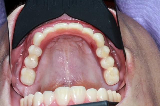 #### Occlusal view 
*6/9* * *